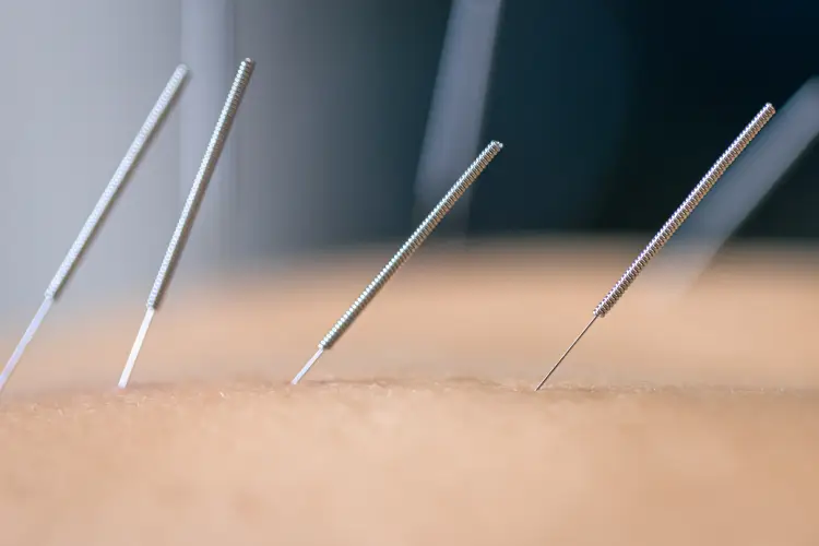 Acupuncture Calgary.jpg
