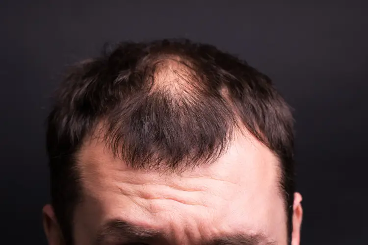 male-hair-loss-treatment.jpg