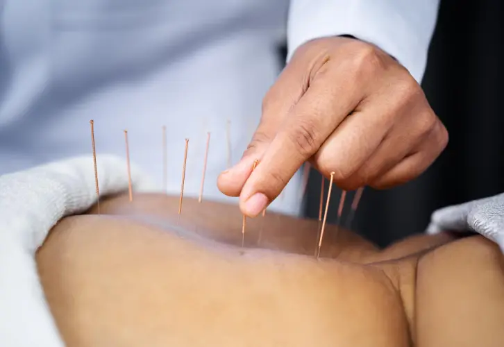 male acupuncturist-applying-needles.jpg