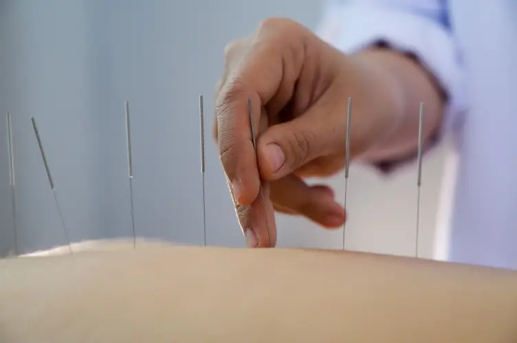 closeup-of-acupuncture-needles-in-back.jpg