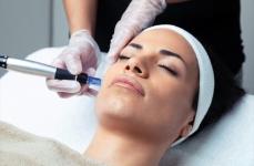 Exosomes Microneedling Treatment for Advanced Skincare - Toronto - Specialist Consultations listing