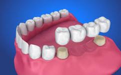 Restore Your Smile with Expert Crowns & Bridges in Canada - Toronto - Specialist Consultations listing