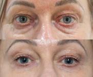 Non Surgical Blepharoplasty Toronto Using Tixel Medical Device - photo 2 / 2